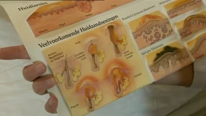 Pukkeltjes in je gezicht