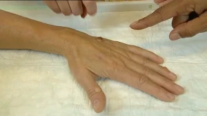 Een eeltachtige vergroeiing 