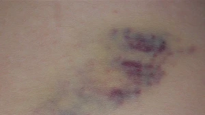 Een bloeduitstorting onder de huid