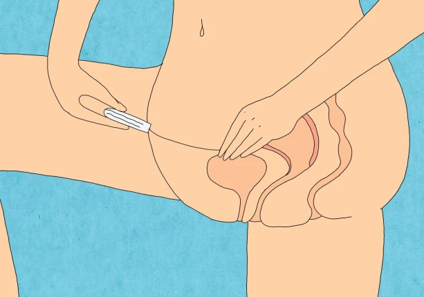 kan een tampon in je baarmoeder komen