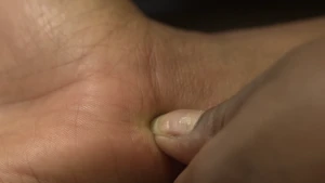 Foto van de hand van iemand die met de duimnagel er in prikt (kruisje maakt in muggenbult).