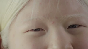 Een foto van het gezicht van Xueli. Het witte haar, de witte wenkbrauwen, de ogen, witte huid en bovenste deel van de neus zijn te zien. Ze heeft albinisme, weinig pigment in ogen, haar en huid, waardoor huid en haar lichter zijn dan bij de meeste mensen.