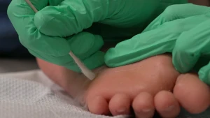 Een foto van de onderkant van een voet met daarboven in lichtgroen plastic gehandschoende handen. De rechterhand heeft een wit wattenstaafje vast, waarvan het zachte puntje op de voet drukt. Dit is om een wratje op de voet te bevriezen met stikstof.