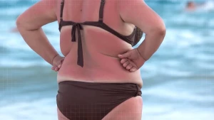 Een foto van een vrouw in bikini, je ziet haar vanaf de achterkant, ze is verbrand.