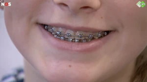 Een close up foto van een mond met een blokjesbeugel, je ziet de onderste helft van een gezicht van een kind.